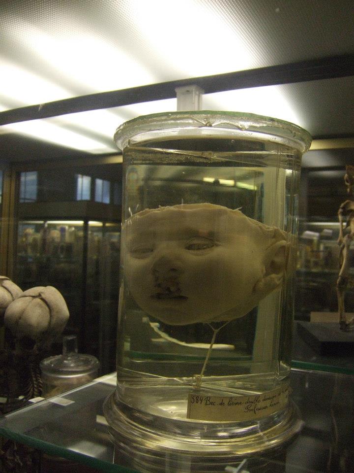 Autopsied baby head-Dupuytren-museum