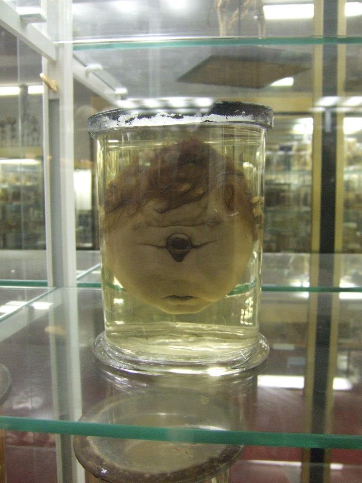 Cyclops-baby-head-Dupuytren-museum