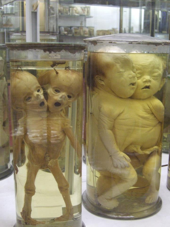 Siamese-babies-Dupuytren-museum
